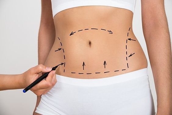 Abdomen Liposuction For Women