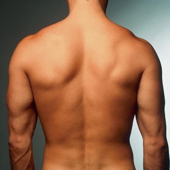 Back Liposuction In Men