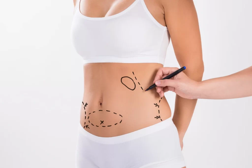 Liposuction In Dubai, Welcome To Bellaroma Specialty Hospital, Your Premier Destination For Comprehensive Body Contouring And Weight Loss Treatment In Dubai