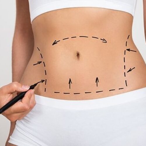 Liposuction Overtakes Breast Augmentation As Most Popular Cosmetic Surgery
